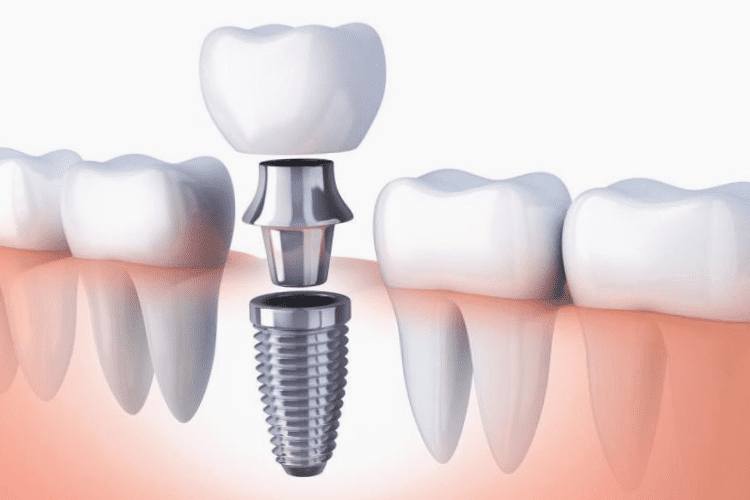 Clínicas de implantes dentário